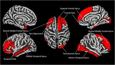 Gyrification in relation to cortical thickness in the congenitally blind